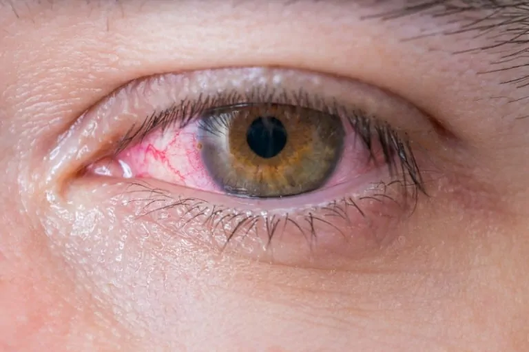 Глаукома – опасно очно заболяване! Фактори за появата й