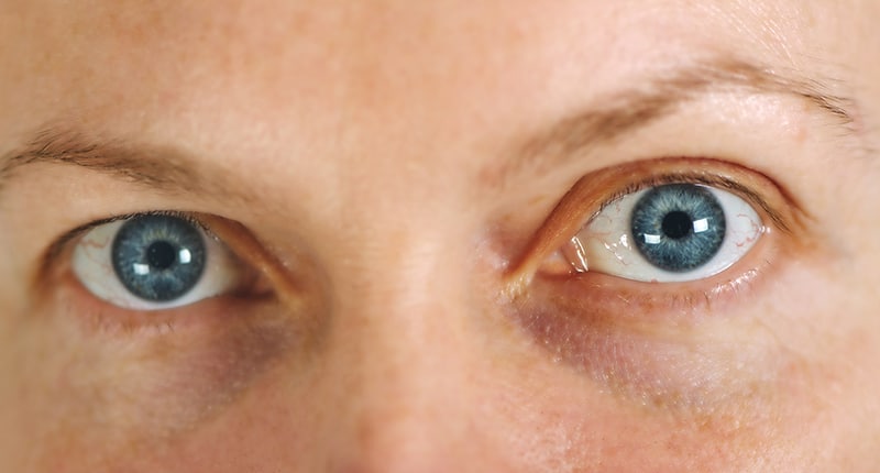 Глаукомата – тихия убиец на зрението