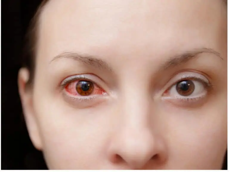 конюнктивитът заразен ли е