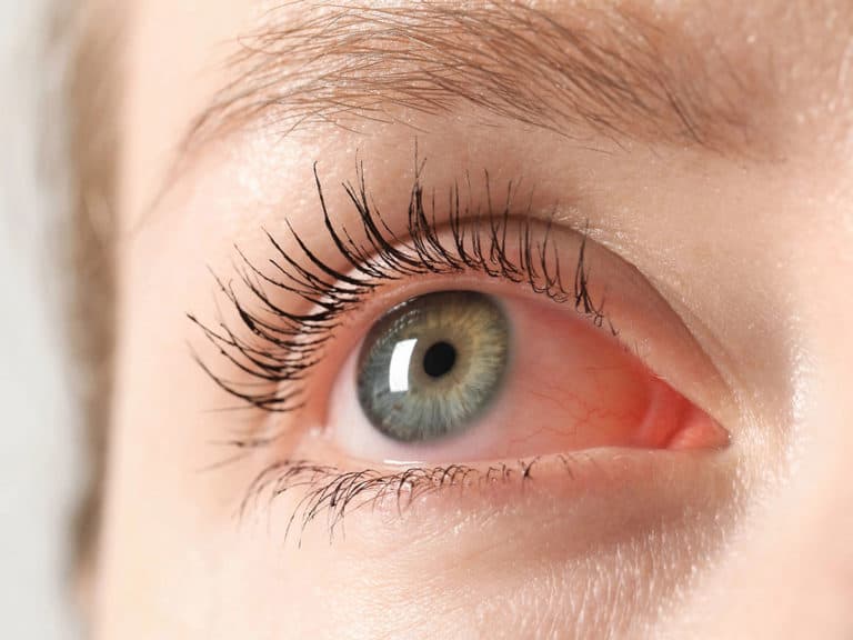 Конюнктивит